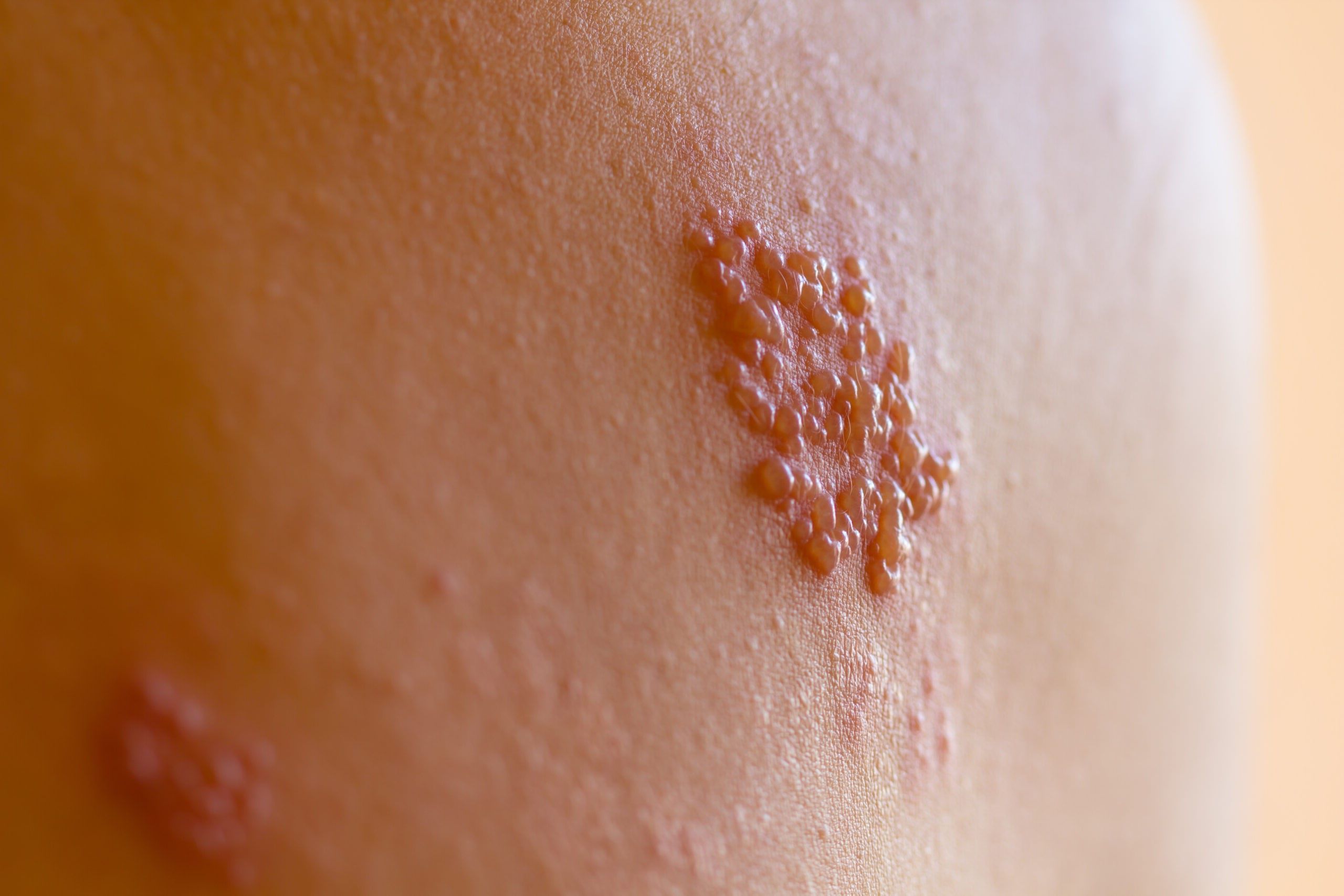 Can Running Cause A Recurrence Of Shingles?