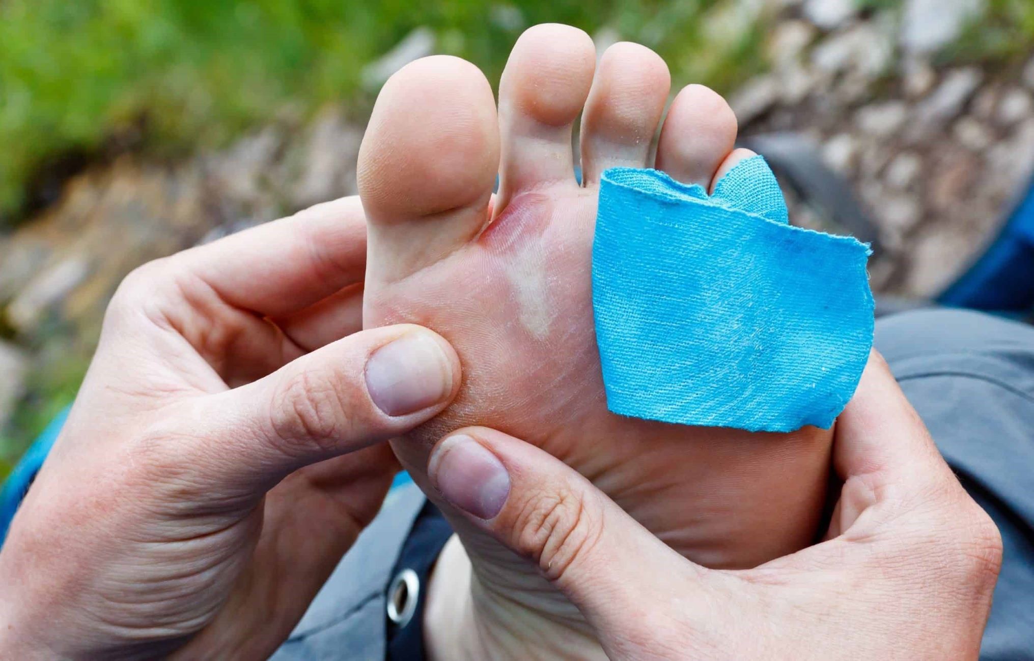 Preventing And Treating Blisters: A Guide For Runners