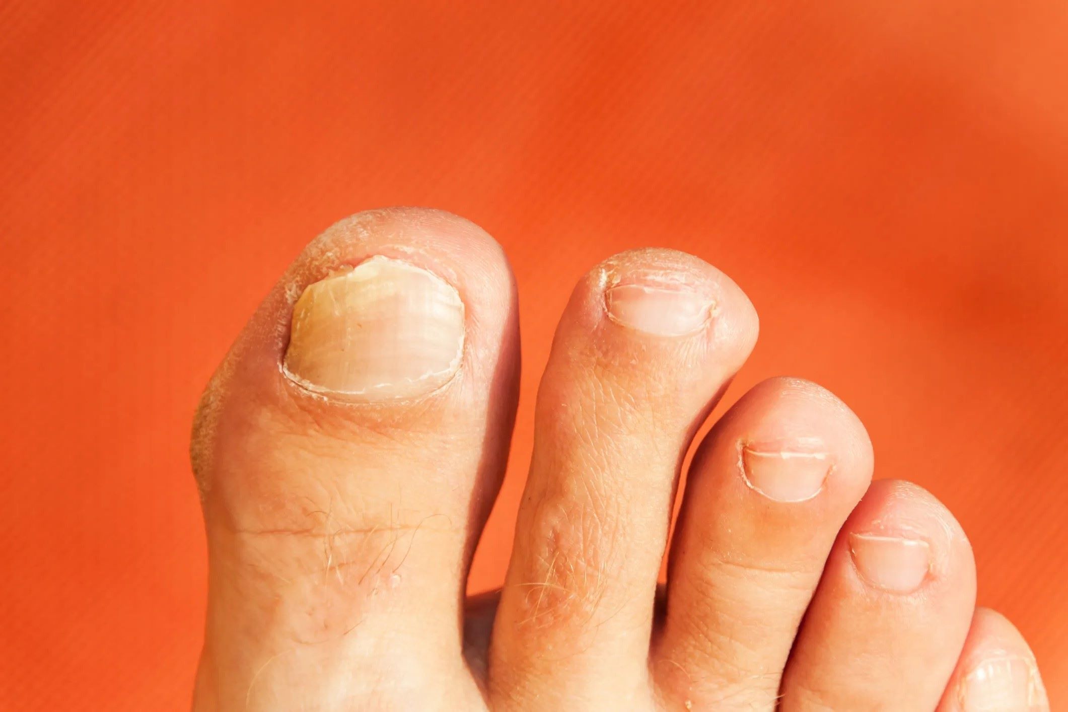 The Essentials Of Fungal Toenail Infections