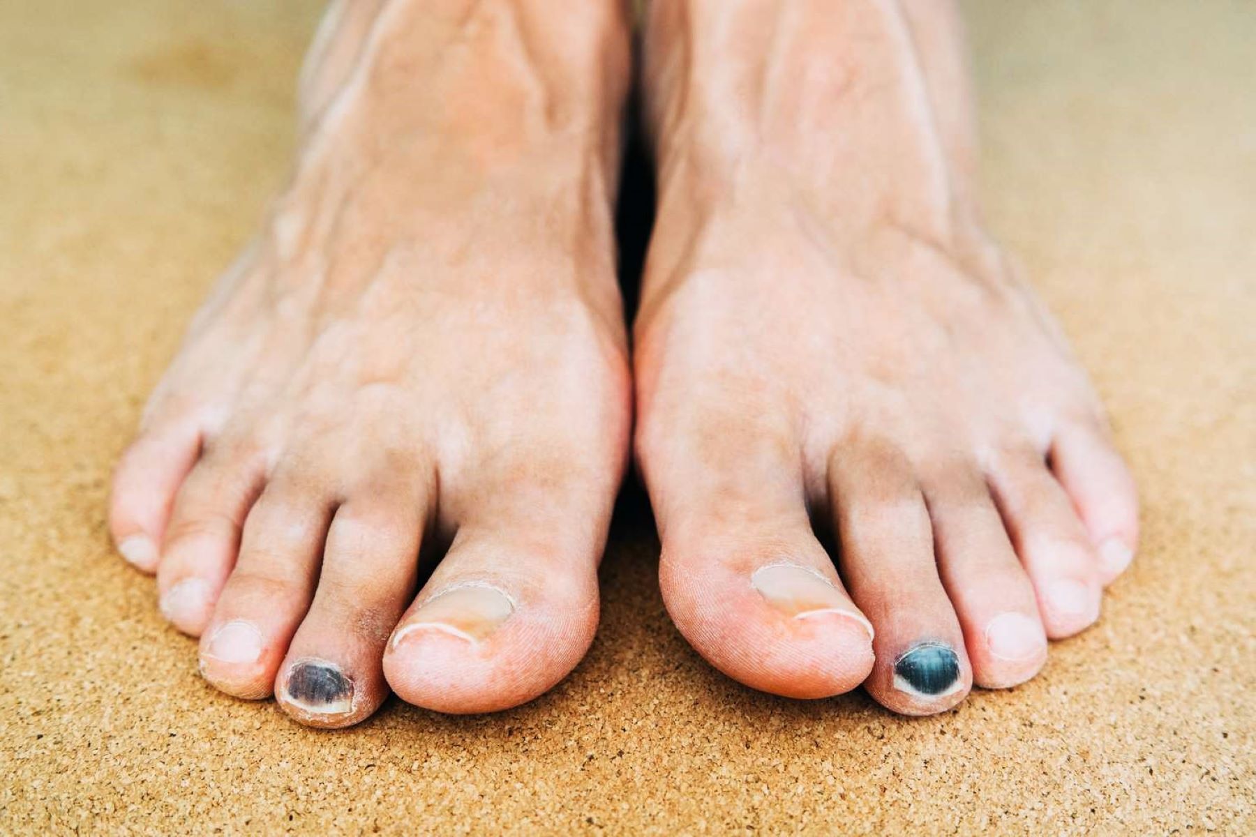 Treating Bruised Toenails: What's The Most Effective Method?