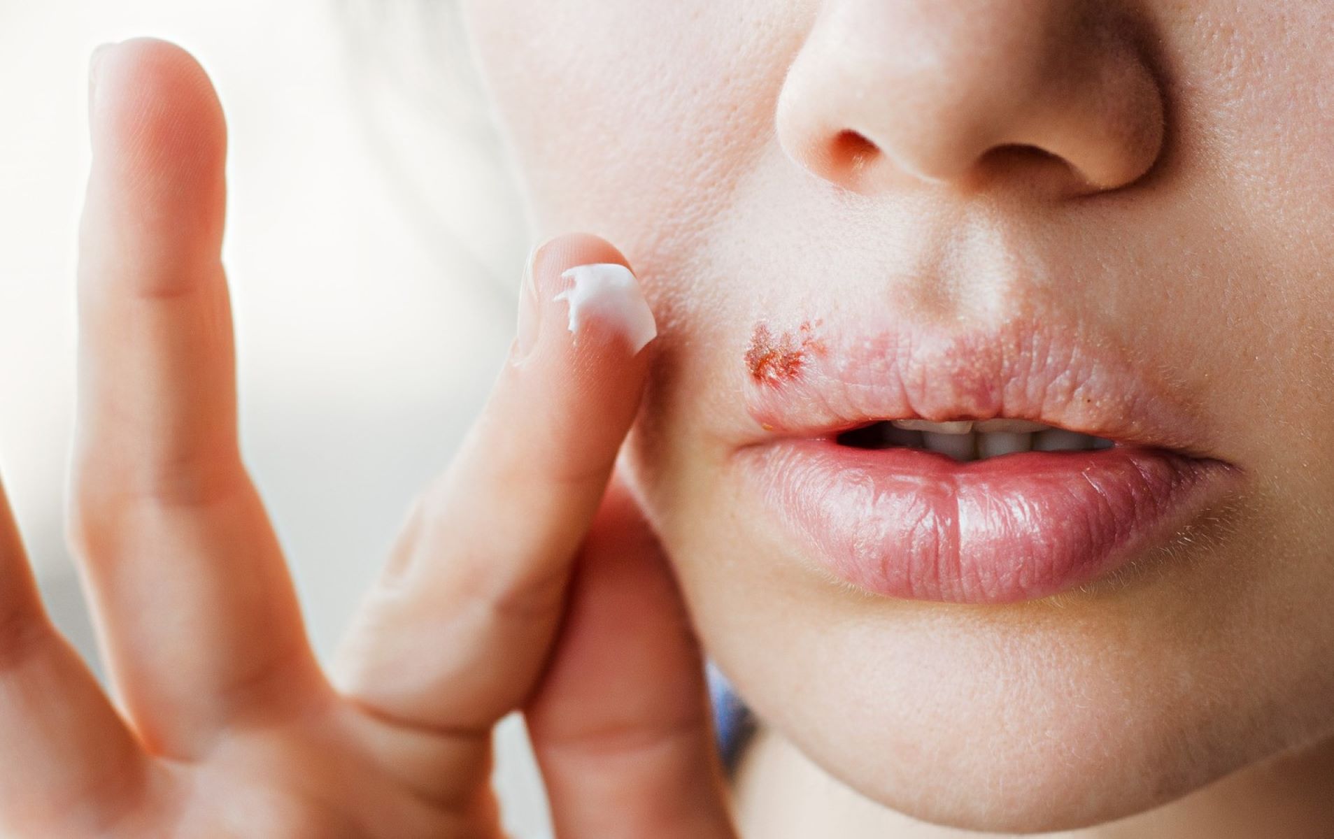 Dealing With Cold Sores After A Long Run